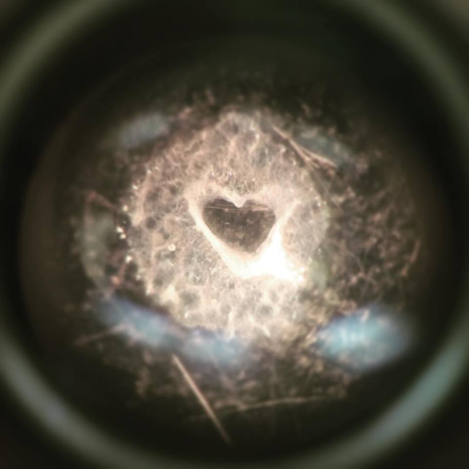 scope image of a heart shape in a human airway